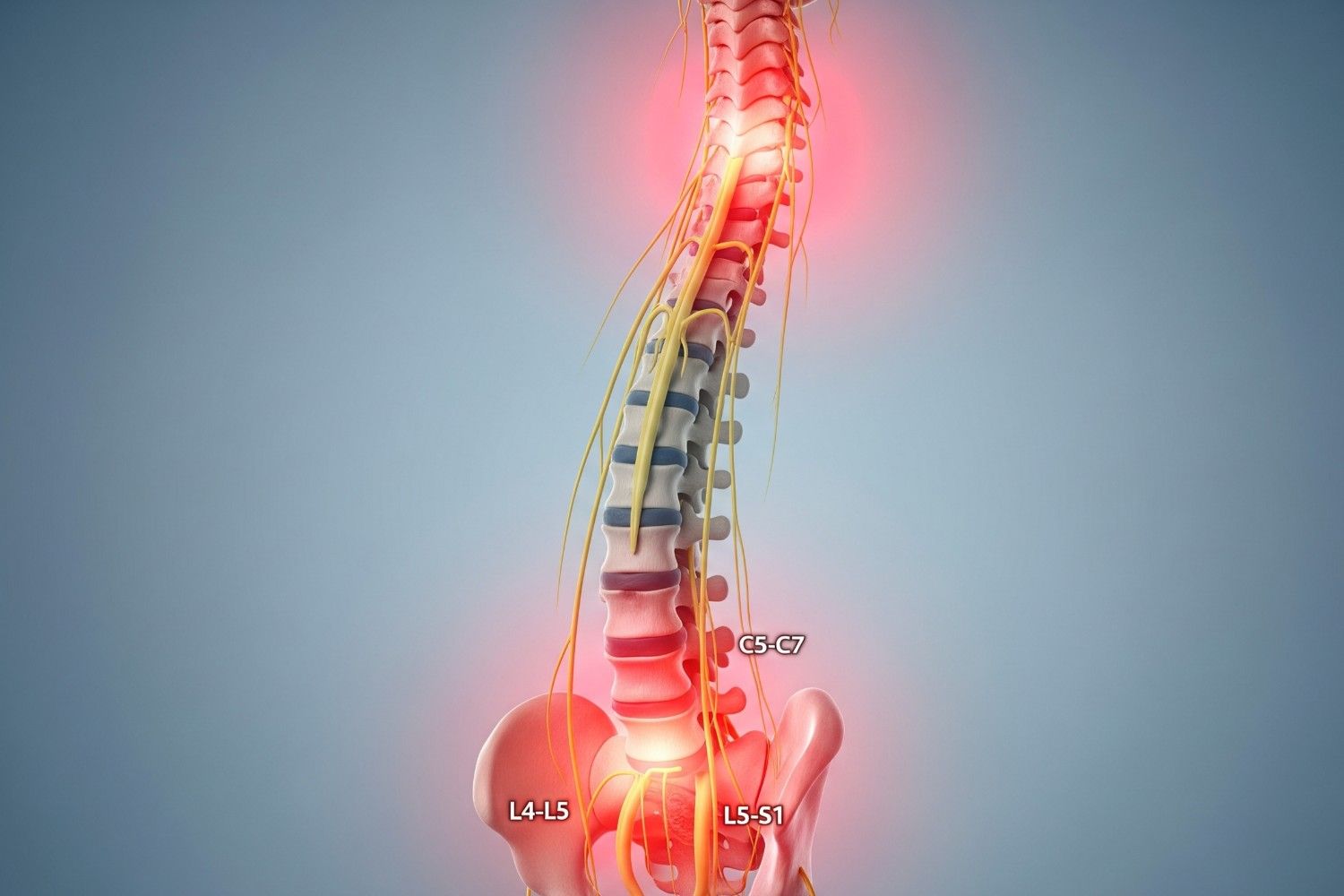 Anatomical diagram of spine showing areas commonly affected by chronic back pain and persistent back pain